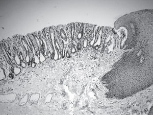 Columnar epithelium in distal esophagus without intestinal metaplasia (Barrett's esophagus of gastric type).