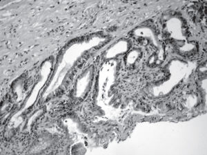 Tubular adenocarcinoma with foveolar structure (originated in gastric cells).