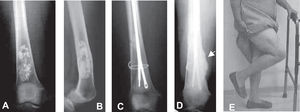 Patient with a grade I chondrosarcoma who underwent an intralesional resection. A) and B) Preoperative radiograph of the distal femur showing well-organized calcific rings within the matrix and cortical bulging and endosteal erosion indicative of a low-grade chondrosarcoma. C) Postoperative radiograph. The tumor area was filled with methyl-methacrylate and Ender nails. D) One year after surgery; radiograph shows callus formation at the site of a non-displaced fracture that was treated conservatively. E) Functional aspect (knee flexion) of the surgically treated limb 1 month after surgery.