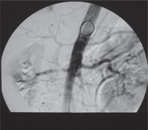 Renal arteriography showing right renal artery stenosis (arrow).