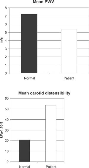 Vascular data obtained in a group of 10 healthy women aged 14 ± 3 years compared to that of the patient with Goldenhar syndrome: mean pulse wave velocity values (Panel A) and mean carotid distensibility values (Panel B). PWV: Healthy women 7.2 ± 1.2 m/s; patient 5.4 m/s; Carotid distensibility: Healthy women 20.7 ± 5 m/s; patient 53.5 m/s.