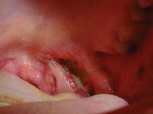 Bacterial tonsillitis and abscess.