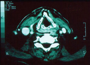 Computed tomography of the neck showing diffuse thickening and infiltration of the cutis and subcutis; diffuse enhancement of the superficial and deep cervical fasciae; thickening of the platysma, sternocleidomastoid, and strap muscles; and air and small amounts of fluid buildup in multiple neck compartments.