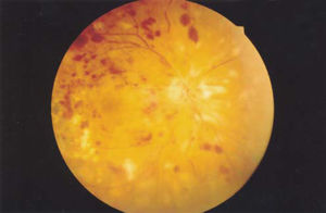 Color retinography of the right eye after the cryoablation and the intravitreal injection. Two days before this picture, before the treatment, the cornea was edematous and the fundus barely visible. Vascular changes such as venous sheathing, intravascular stop of the blood column, arteriolar thinning, retinal hemorrhages, and cotton wool spots were also visible throughout the entire fundus