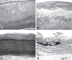 Atherosclerotic lesions showing: (A) thick fibrous plaque; (B) fat plaque with many cholesterol clefts; (C) small fibrous plaque and preserved medial layer; (D) superficial ulceration and medial layer presenting massive destruction of elastic fibers. A and B Masson's trichrome stain; C and D Verhoeff's stain for elastic fibers. Bar = 500 μm
