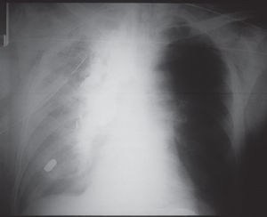 Severe right pulmonary contusion and esophageal perforation. Note leak of barium into right chest
