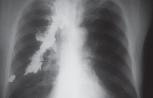 Postoperative chest roentgenogram several weeks after the treatment of esophageal perforation due to a gunshot wound. No complications related to barium