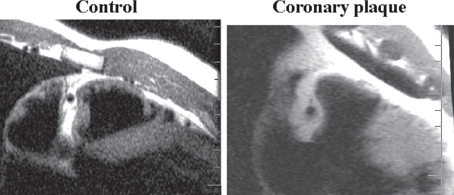 NONINVASIVE DETECTION OF CORONARY ARTERY DISEASE - CHALLENGES FOR ...