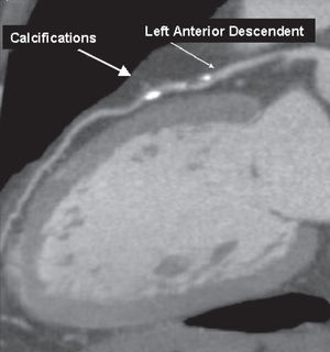 Ultra fast multislice computer tomography of coronary arteries. Calcification of coronary, score 9.8 Agatston,80 75th percentile for age and gender