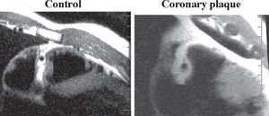 Magnetic resonance of coronary arteries. Observe the increment of wall thickness and total vessel diameter of diseased vessel, a positive remodeling (right) compared to the control (left)104