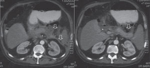 Abdominal CT scan using intravenous and oral contrast media demonstrating small necrotic areas in the head and body of the pancreas, infiltration of peripancreatic fat, and presence of gas in the retrogastric and pararenal spaces (arrows)