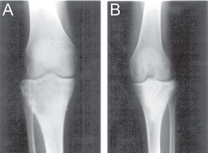 A) Giant cell tumor of proximal tibia. B) Pos-operative radiography