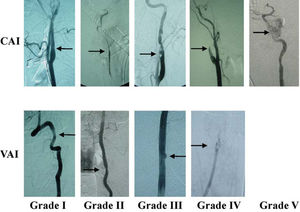 Representative angiographic images of different grades of BCVI Injury Grade: Angiographic Finding; Grade I: Intimal Irregularity, <25% Luminal Stenosis; Grade II: Intimal Irregularity, >25% Luminal Stenosis, Intimal Flap; Grade III: Pseudoaneurysm; Grade IV: Occlusion; Grade V: Transection with active extravasation.