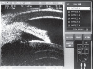 Case 3 ultrasound biomicroscopy (UBM): increase in the thickness of the ciliary body, in a solid form and with variable echogenicity, with impairment of the root of the iris