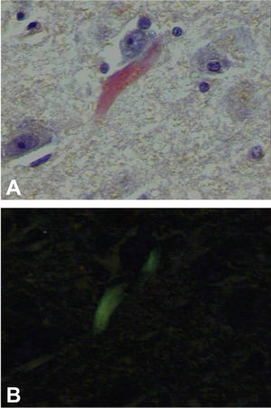 Histological section from the hippocampus of an autopsied patient. Note the deposit of congophilic material, in orange, seen under common light, birefringent in apple-green under polarized light, characterizing amyloidosis (Congo-red stain, 40x, under common light – A and under polarized light – B)