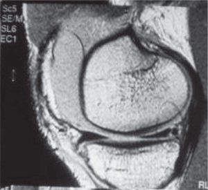 NMR image showing a medial meniscal injury