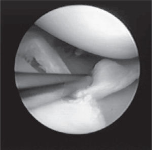 Arthroscopy of knee showing a “pail-handle” meniscal injury