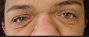 Preoperative view showing a cutaneous excess on the lower eyelid before resection of the upper eyelid skin and lateral canthal suspension