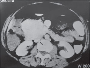 Computed tomography of the abdomen with a solid mass (large arrow) in the area at the level of the head of the pancreas, showing the proximity between the mass and the inferior vena cava (small arrow)