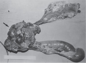 Resected product of partial gastroduodenopancreatectomy (Whipple's procedure) with a well-circumscribed nodular mass in the head of the pancreas (arrow)