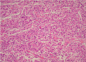 Micrograph of a histological section of the pancreatic tumor showing monomorphic tumor cells growing in an organoid pattern characterized by nests, sheets, and ribbons. The tumor cells are small, round to oval, with nuclei showing “salt and pepper” chromatin and with prominent granular eosinophilic cytoplasm. The histological pattern is consistent with a carcinoid tumor (hematoxilin & eosin staining; original magnification, X200)