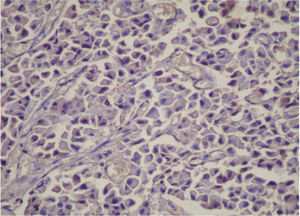 Immunohistochemistry of the pancreatic tumor showing serotonin-positive expression in neoplastic cells (immunoperoxidase, X400)