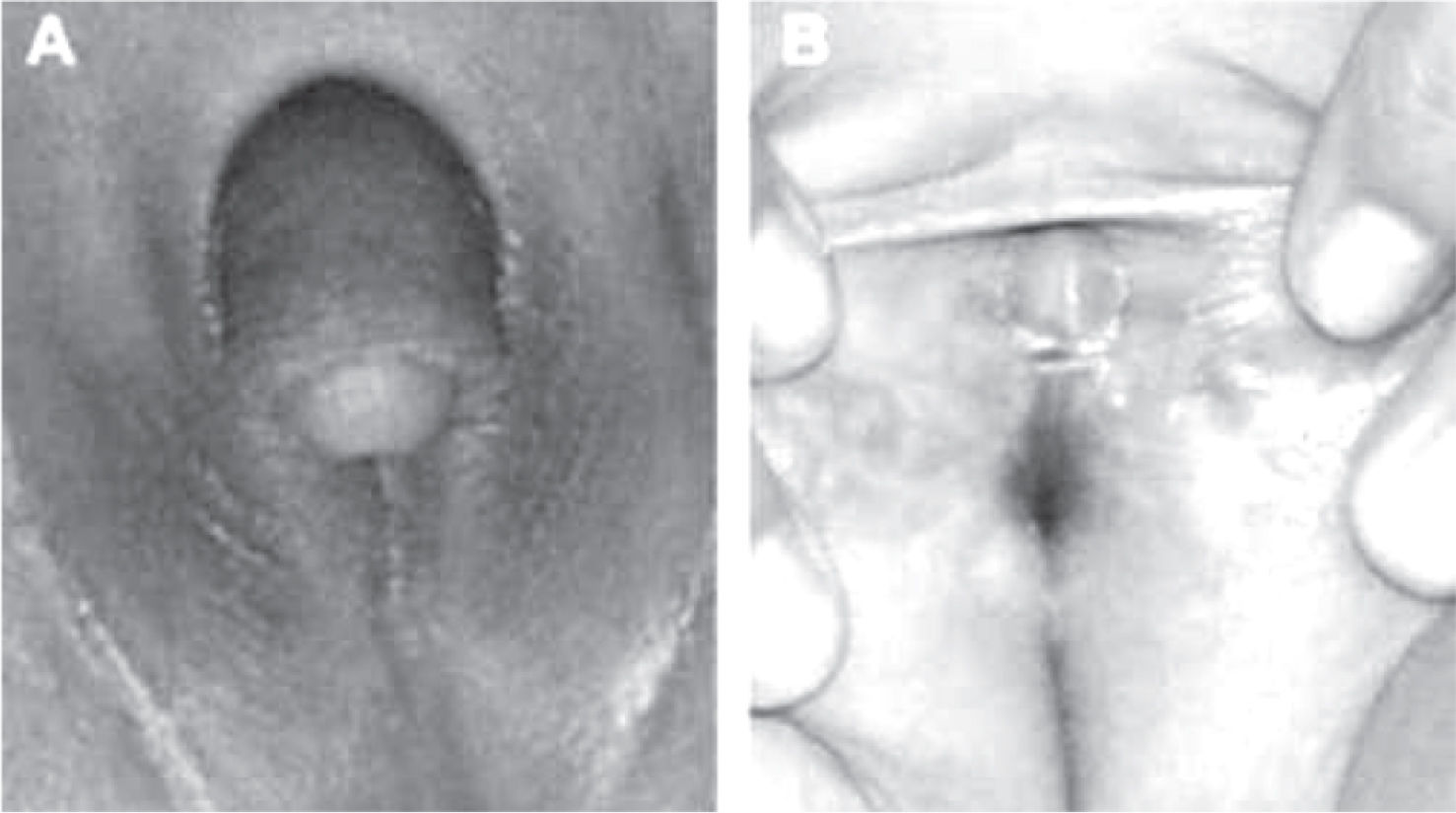 clitorectomy Is nerve sparing clitoroplasty really a nerve sparing? | African Journal of  Urology | Full Text