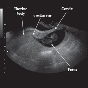 Transvaginal two-dimensional ultrasonography showing a fetus without heart activity, measuring 38.0mm of crown-rump length, located in the cervical portion of the uterus (abortion or cervical pregnancy?). Note the ultrasound image of the previous cesarean-section scar.