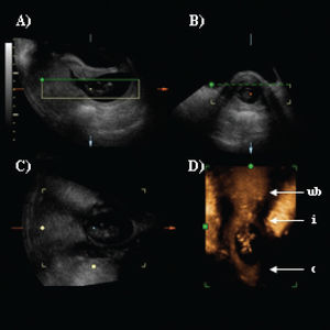 Multiplanar imaging with the three orthogonal sections: a) sagittal section, b) transversal section, c) coronal section, and d) reconstructed three-dimensional image. The depth of the sectional plane of the render box was adjusted on the A-plane (sagittal section) in order to evaluate the isthmus on the C-plane (coronal section). Note that, on coronal section and on the rendered 3D image, it is possible to delineate the upper limit of the cervical pregnancy at the constricted isthmus (i). ub: uterine body; i: isthmus; c: cervix.
