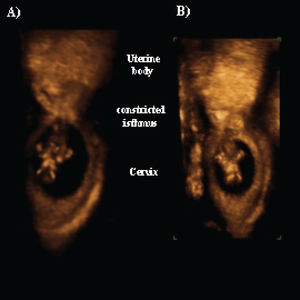Three-dimensional sonogram (rendered images) showing the precise location of the pregnancy inside the cervix, with the constricted isthmus being the upper limit of the cervical pregnancy.