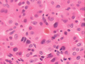 Panel A. Biopsy of orbital mass shows a neoplasm with pseudoglandular, trabecular pattern of polygonal cells, prominent nucleoli, vesicular nuclei, and bile plugs (hematoxylin and eosin staining; magnification, 400x).
