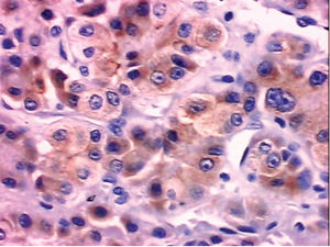 Panel B. Immunohistochernistry shows positive staining of the tumor cells with a low-molecular-weight cytokeratin, CAM 5.2 (magnification, 400x).