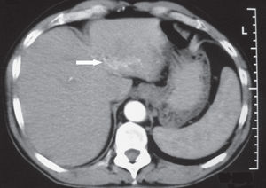 Computed tomography of the abdomen shows a focal perfusion abnormality in the left lobe of the liver (arrow).