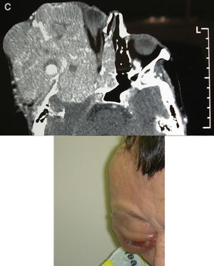 Massive growth of the orbital mass is shown on computed tomography (top) and clinically (bottom).
