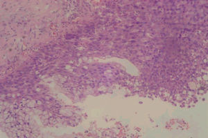 Well-differentiated squamous cell carcinoma associated with nests of large cells with abundant basophilic cytoplasm and basally located nuclei, tending to assume a glandular arrangement (hematoxylin and eosin; original magnification, 100x).