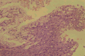 Higher magnification (hematoxylin and eosin; original magnification, 400x).