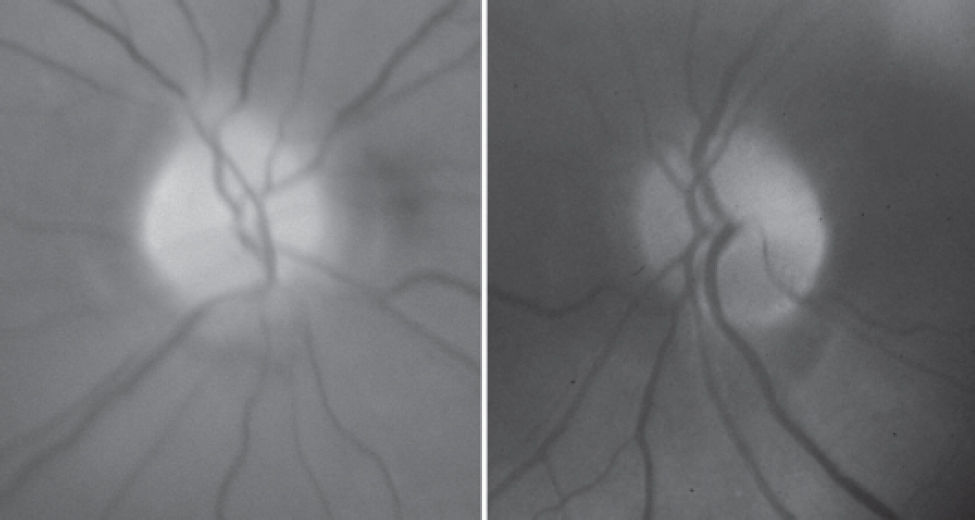 Croded Disc BILATERAL VISUAL LOSS AFTER LIPOSUCTION: CASE REPORT AND REVIEW OF THE ...