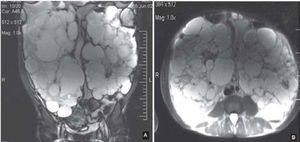 MRI of large kidneys occupying almost the entire abdomen. A – coronal view; B – transversal view
