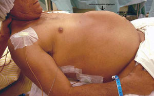 Rectus abdominis diastasis and umbilical hernia in a ADPKD patient