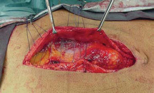 U-shape stitches allowing the overlapping of the borders of the incision