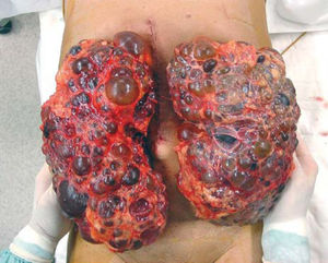 The incision of much smaller size than the kidney, with no emptying of the cyst and no morcellation of the kidney required