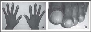 Clubbing and hypertrophic changes of fingers and toes, demonstrating marked clubbing and hypertrophic changes (1A, 1B)