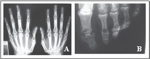 Anteroposterior view of radiographs showing fingers and toes with mushrooming of the tufts (2A, 2B)
