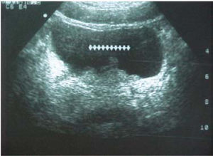 Ultrasonography showing irregularities at the base of the bladder suggesting a bladder tumor