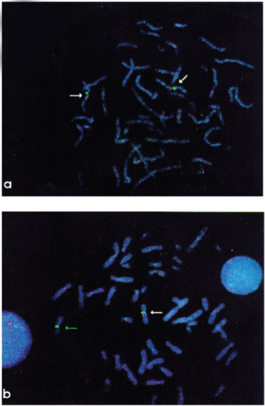 WILLIAMS SYNDROME. DEVELOPMENT OF A NEW SCORING SYSTEM FOR CLINICAL ...
