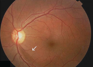 The inferior localized retinal nerve fiber layer defect (arrow)