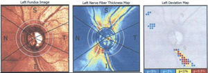 GDx VCC deviation map with a correspondent localized inferior defect in the nerve fiber layer