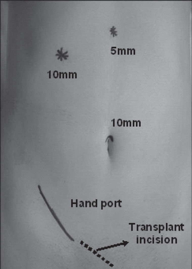 HAND-ASSISTED LAPAROSCOPIC RIGHT NEPHRECTOMY AND AUTOTRANSPLANTATION ...