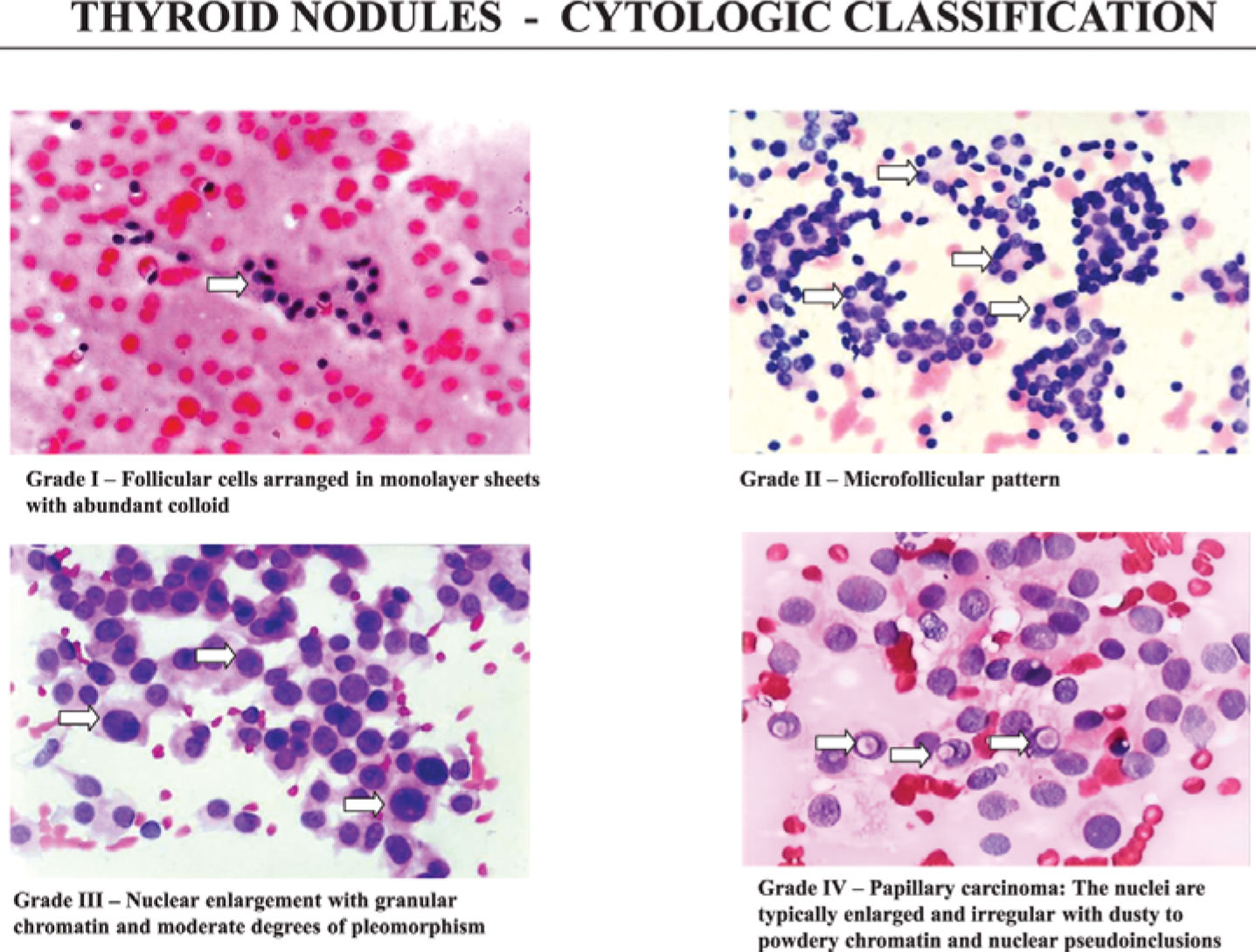 PREOPERATIVE ASSESSMENT OF THYROID NODULES: ROLE OF ULTRASONOGRAPHY AND ...