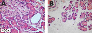 Micrography of pancreas histology of: Group I (A; minimal edema) and Group II (B; pronounced edema) rats. The pancreas segments were stained with a hematoxilin-eosin mixture.